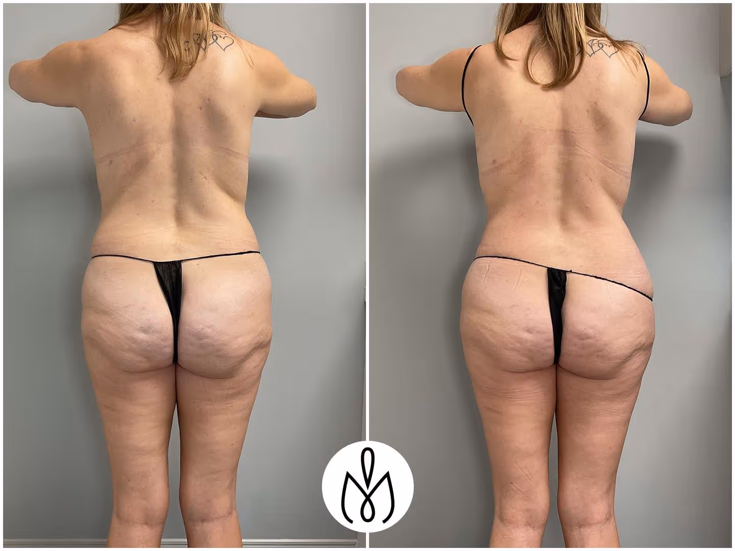Before,After