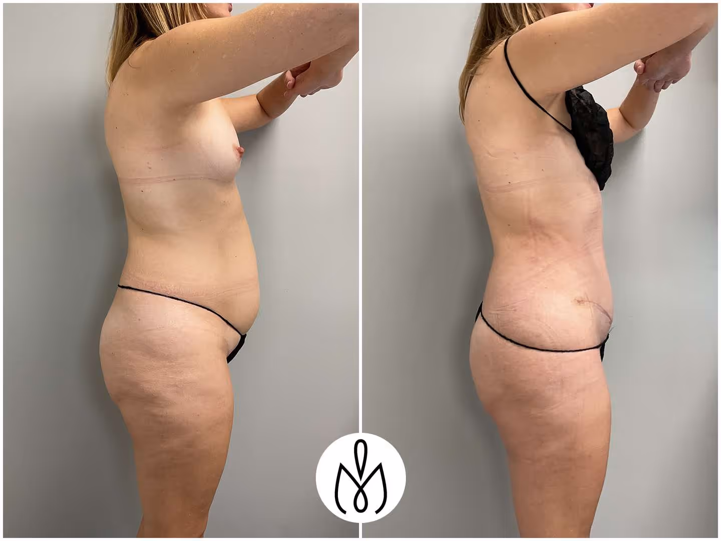 Before,After