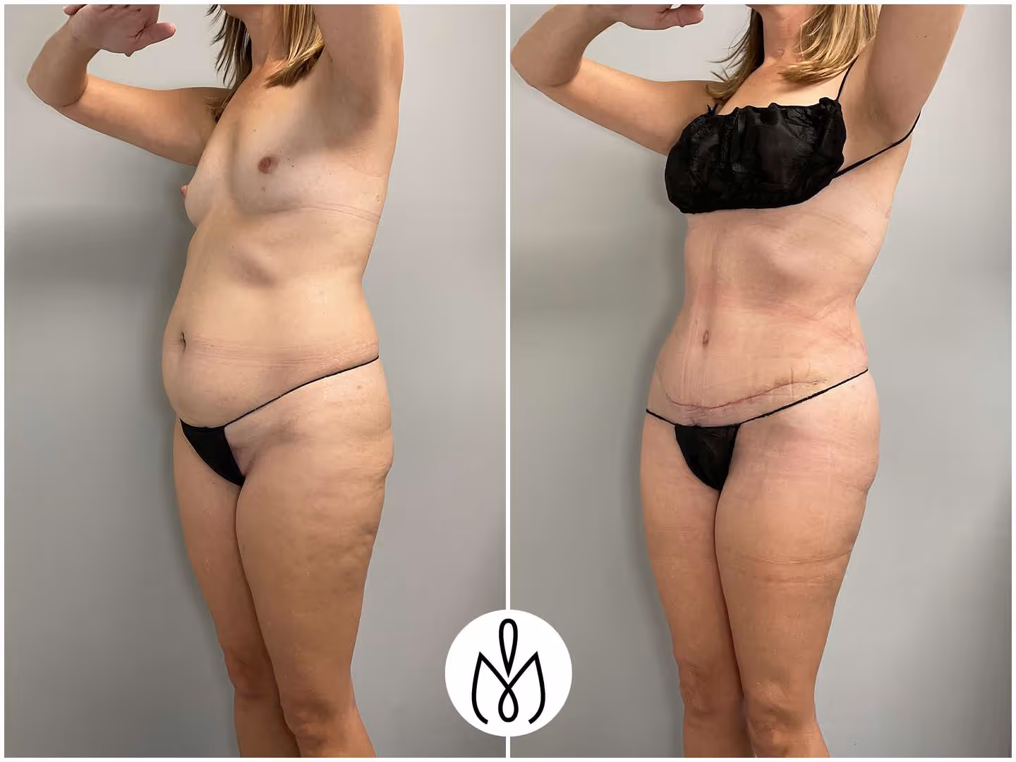 Before,After