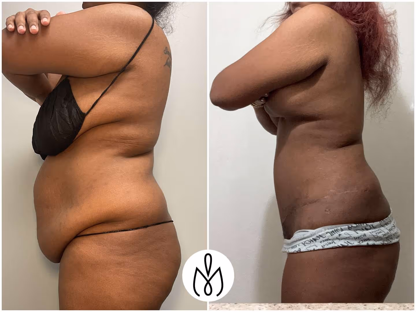 Before,After