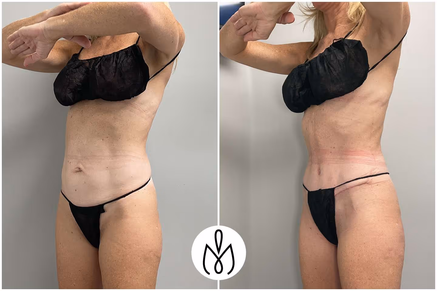 Before,After