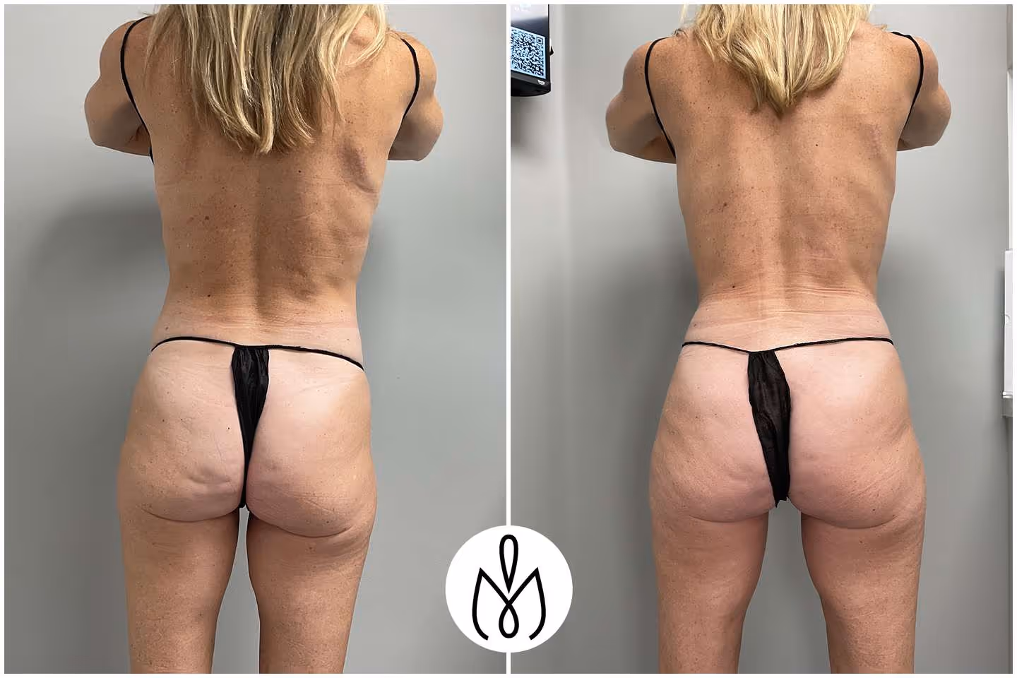 Before,After