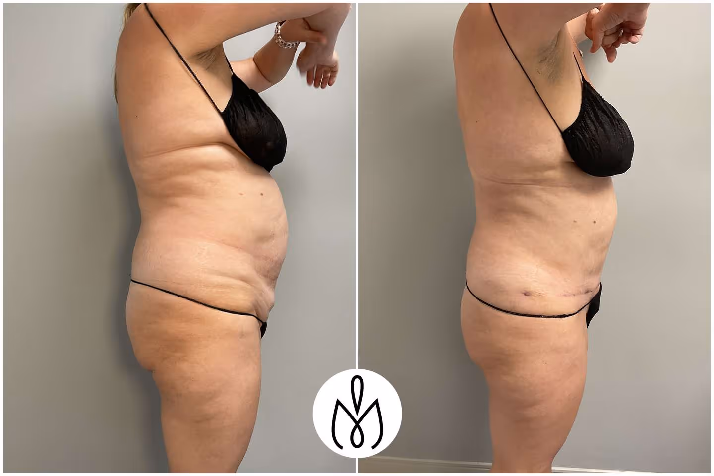Before,After