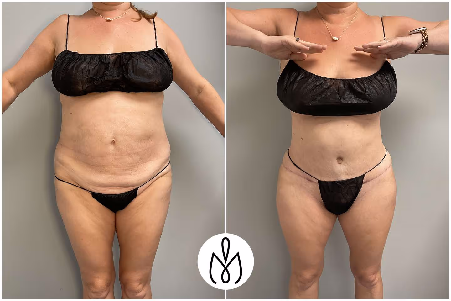 Before,After