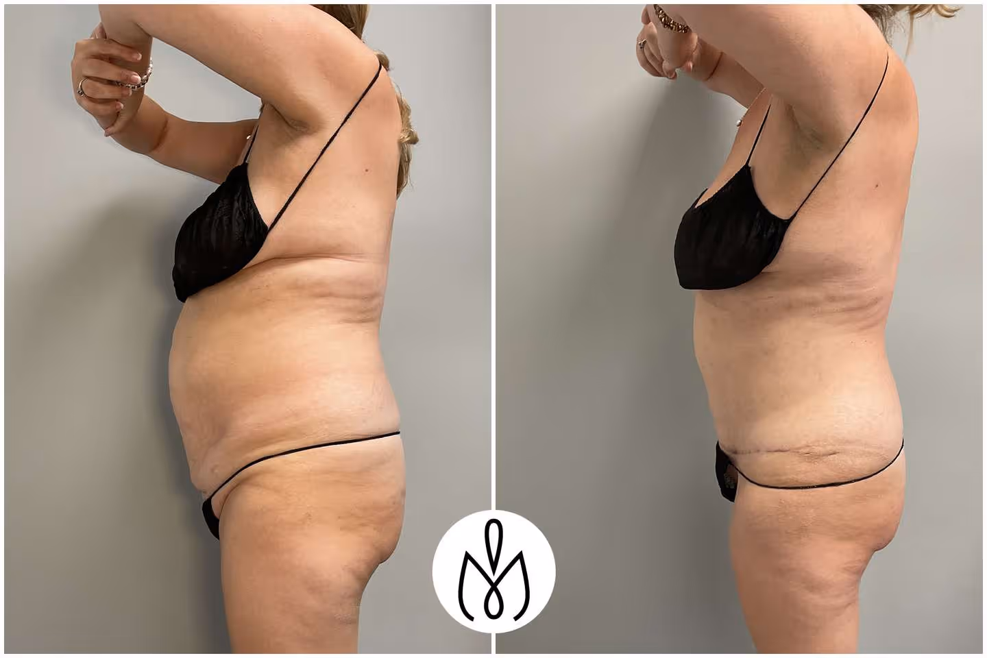 Before,After