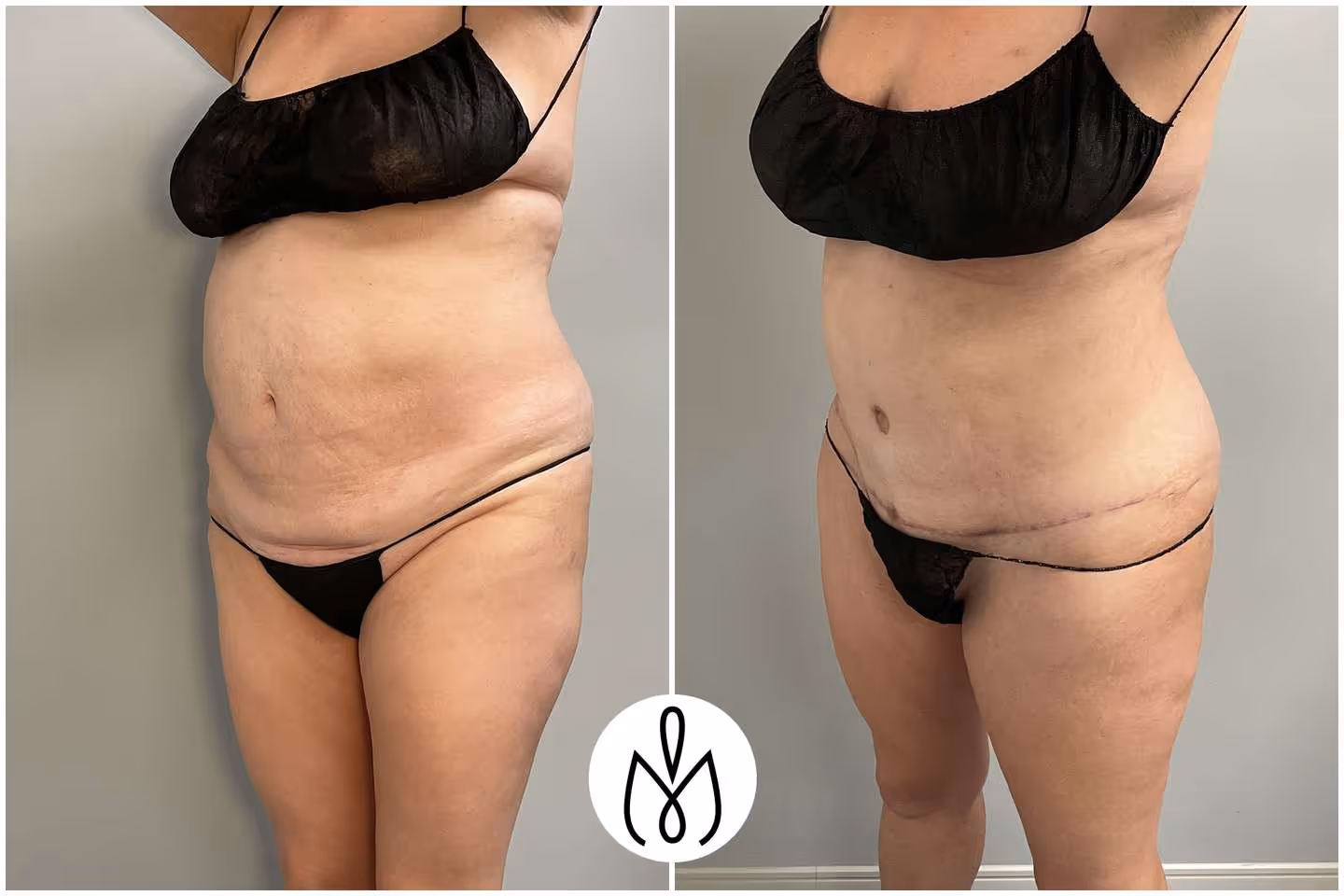 Before,After