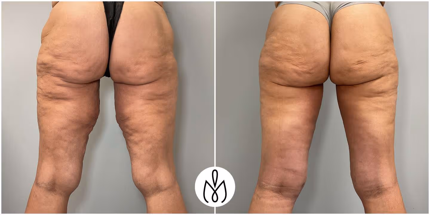 Before,After