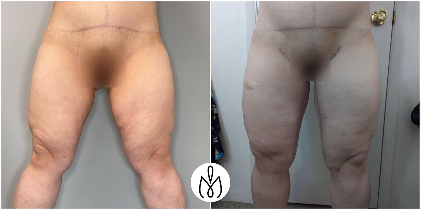 Before,After