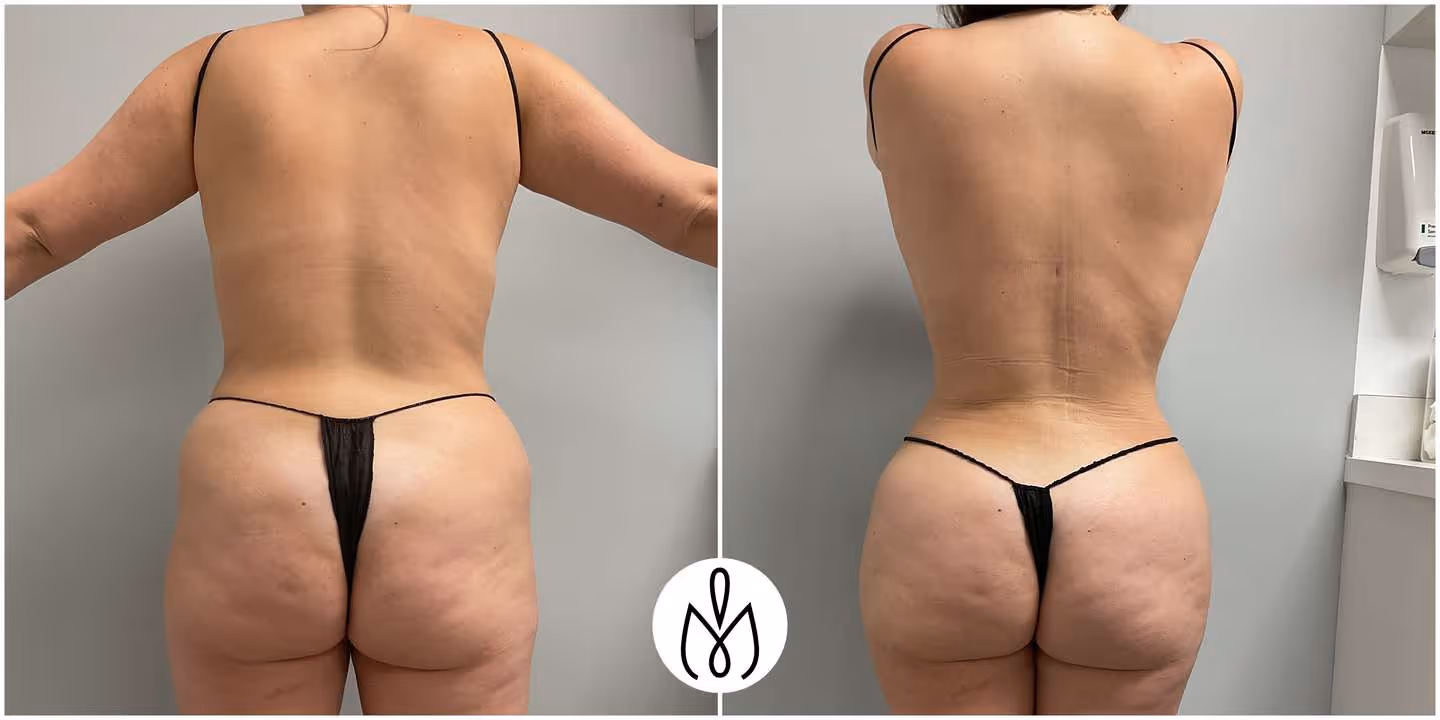 Before,After