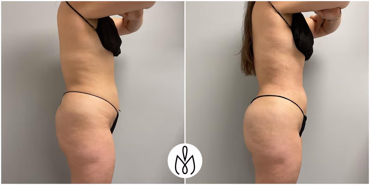Before,After