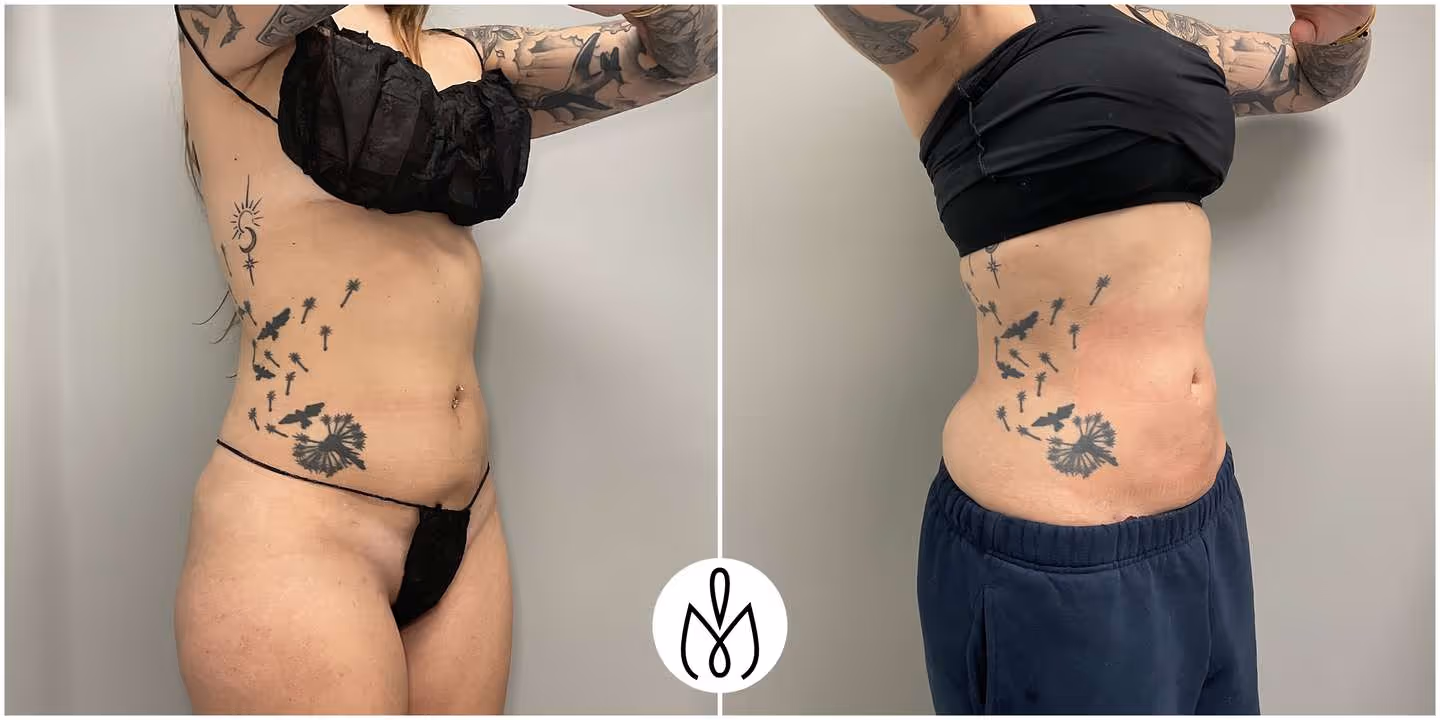 Before,After