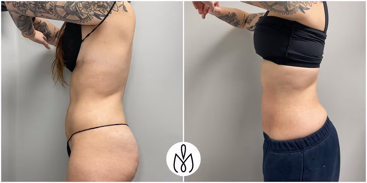 Before,After