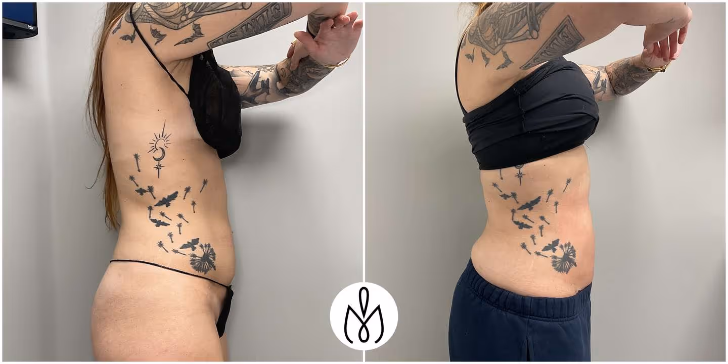 Before,After