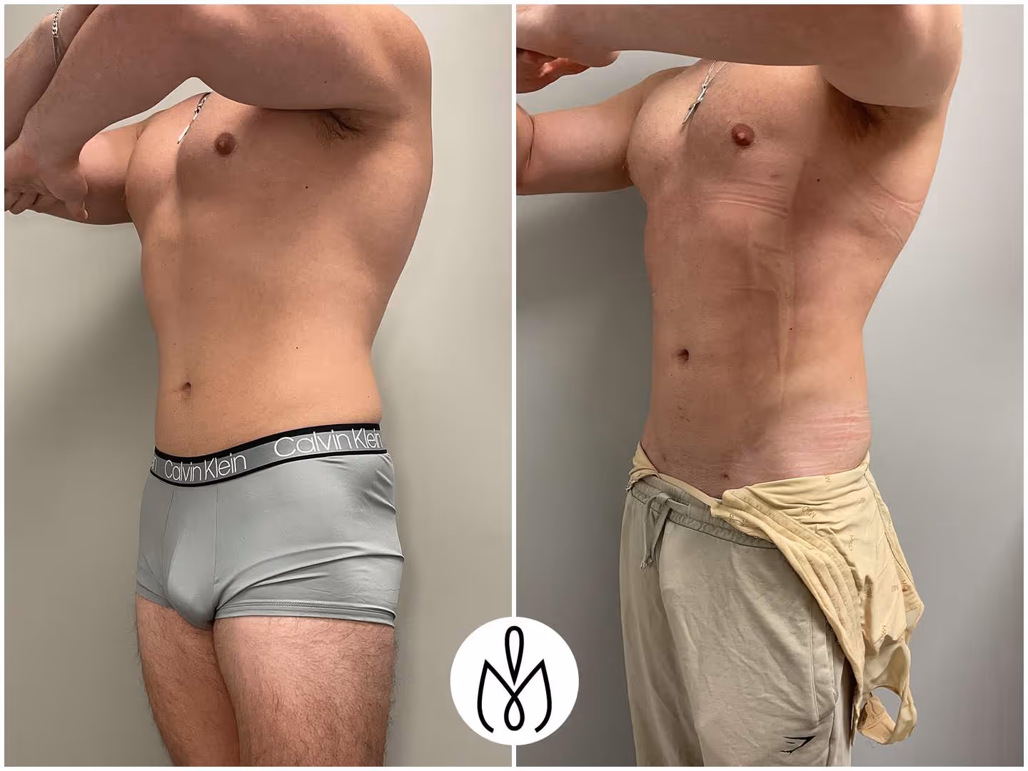 Before,After