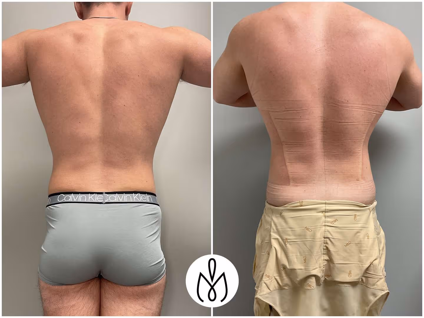 Before,After