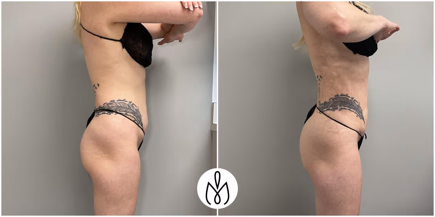 Before,After