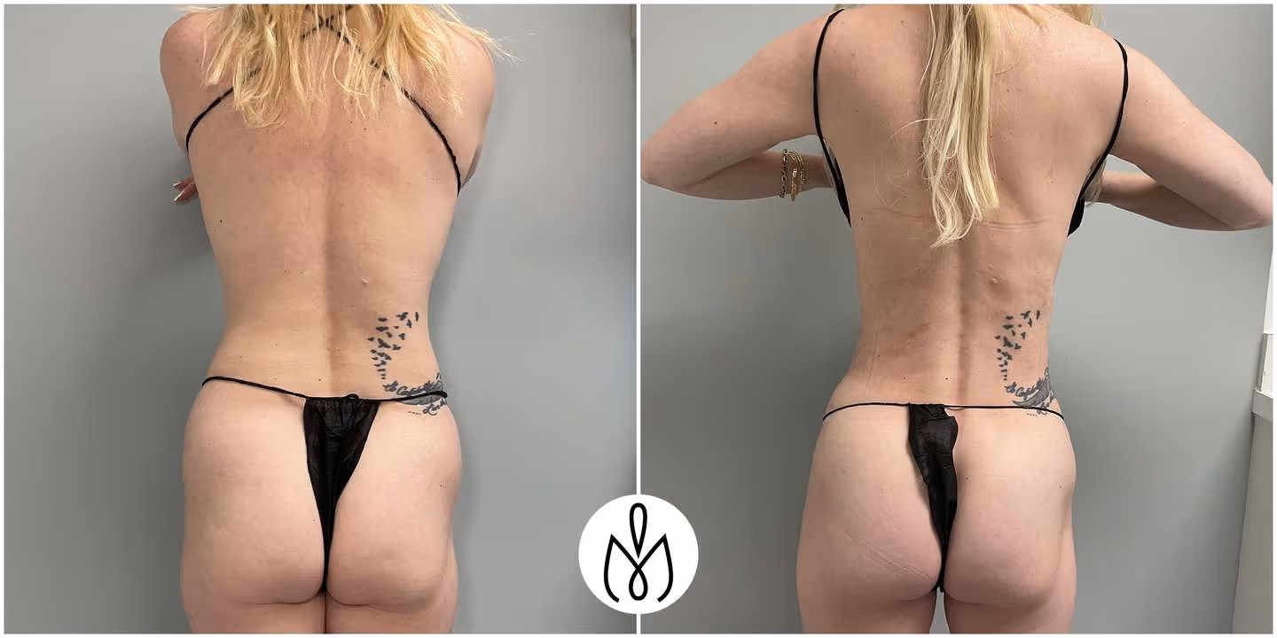 Before,After
