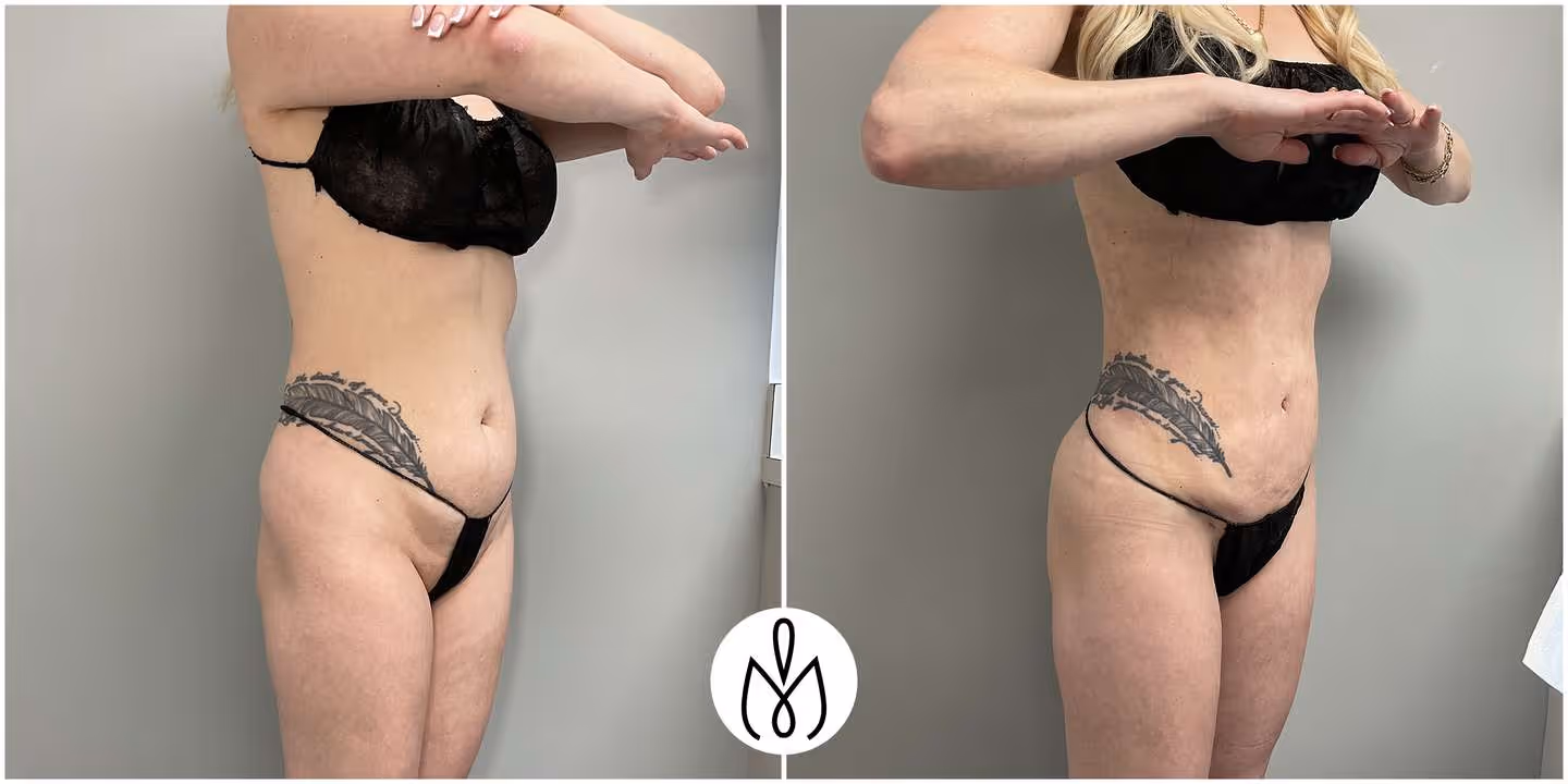 Before,After