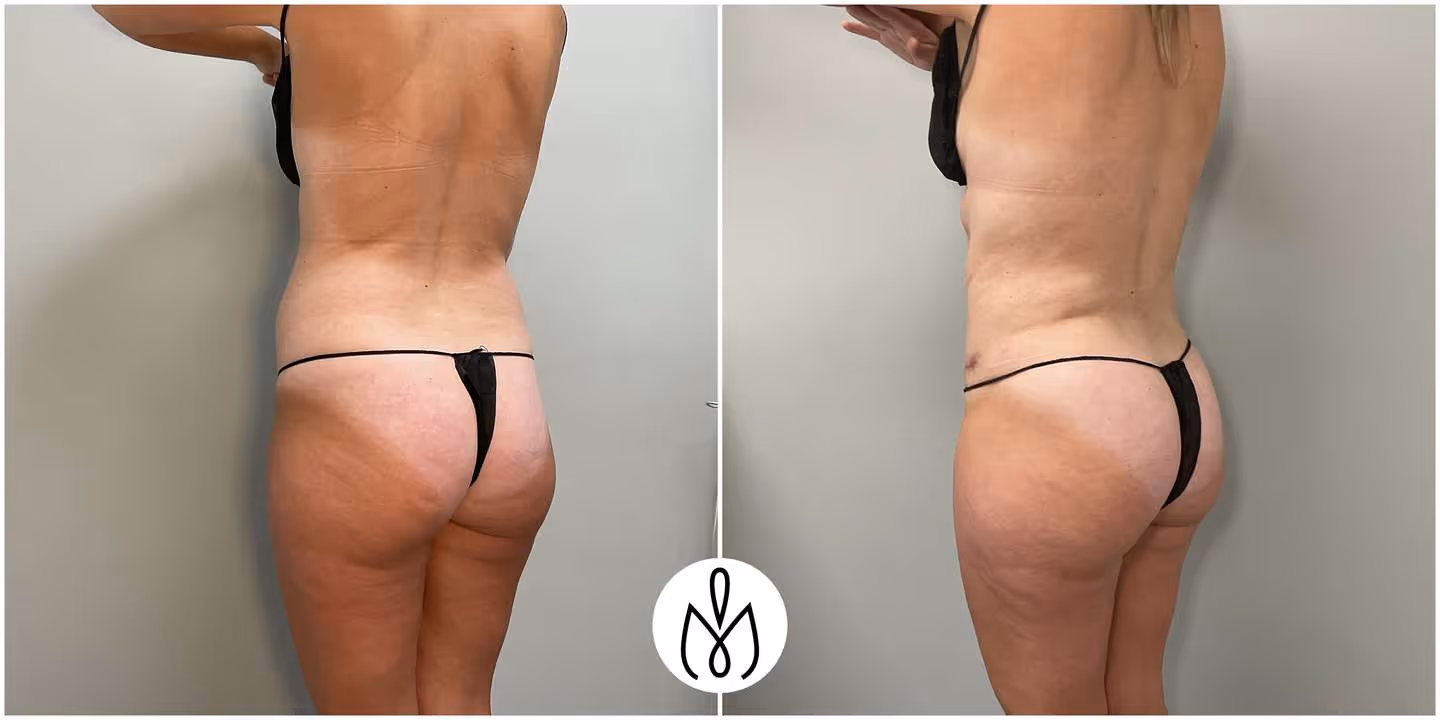 Before,After