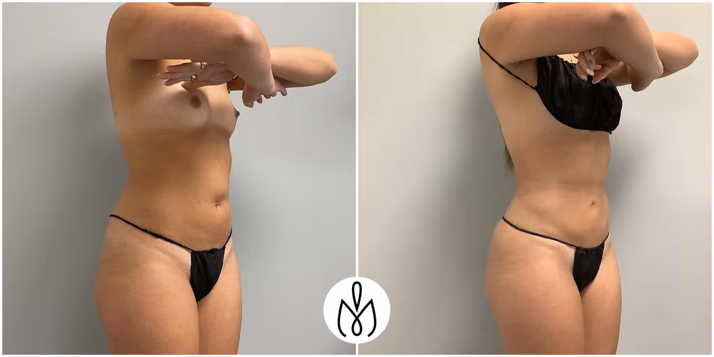 Before,After