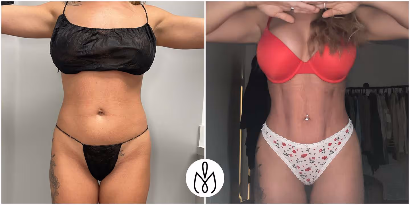 Before,After