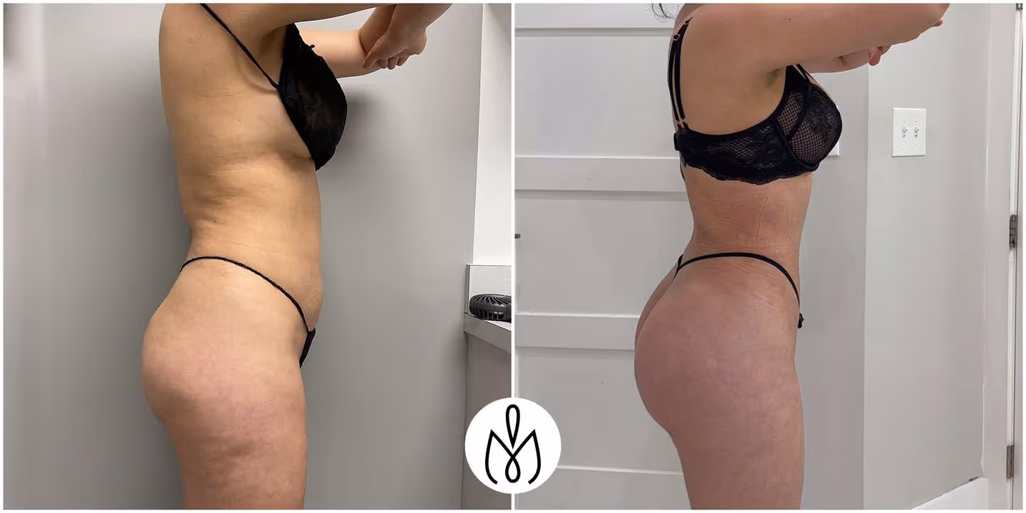 Before,After