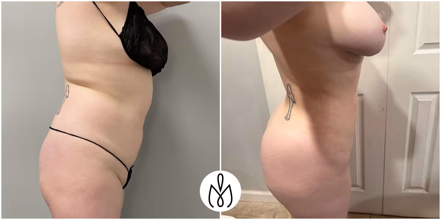 Before,After
