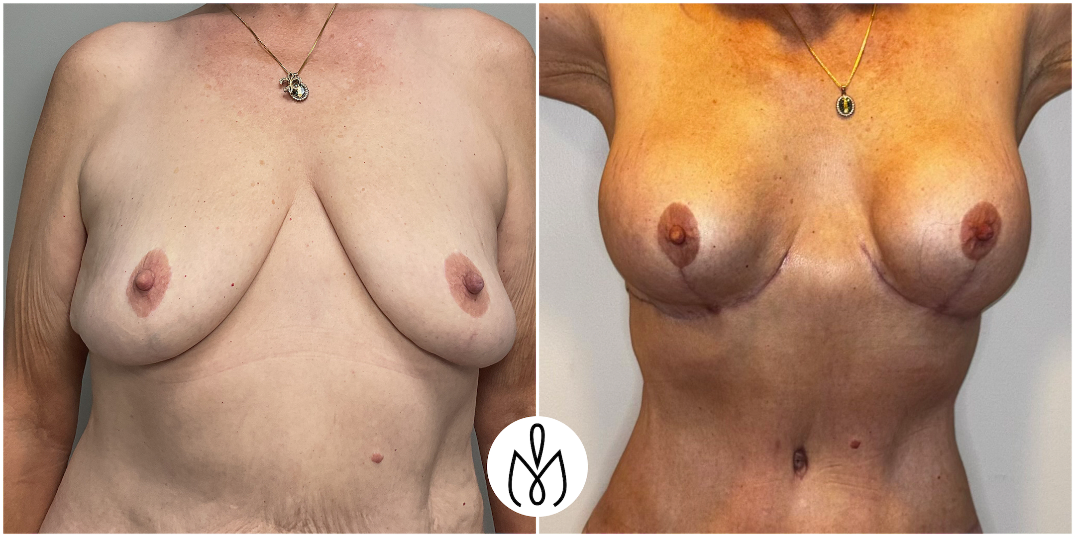 Before,After