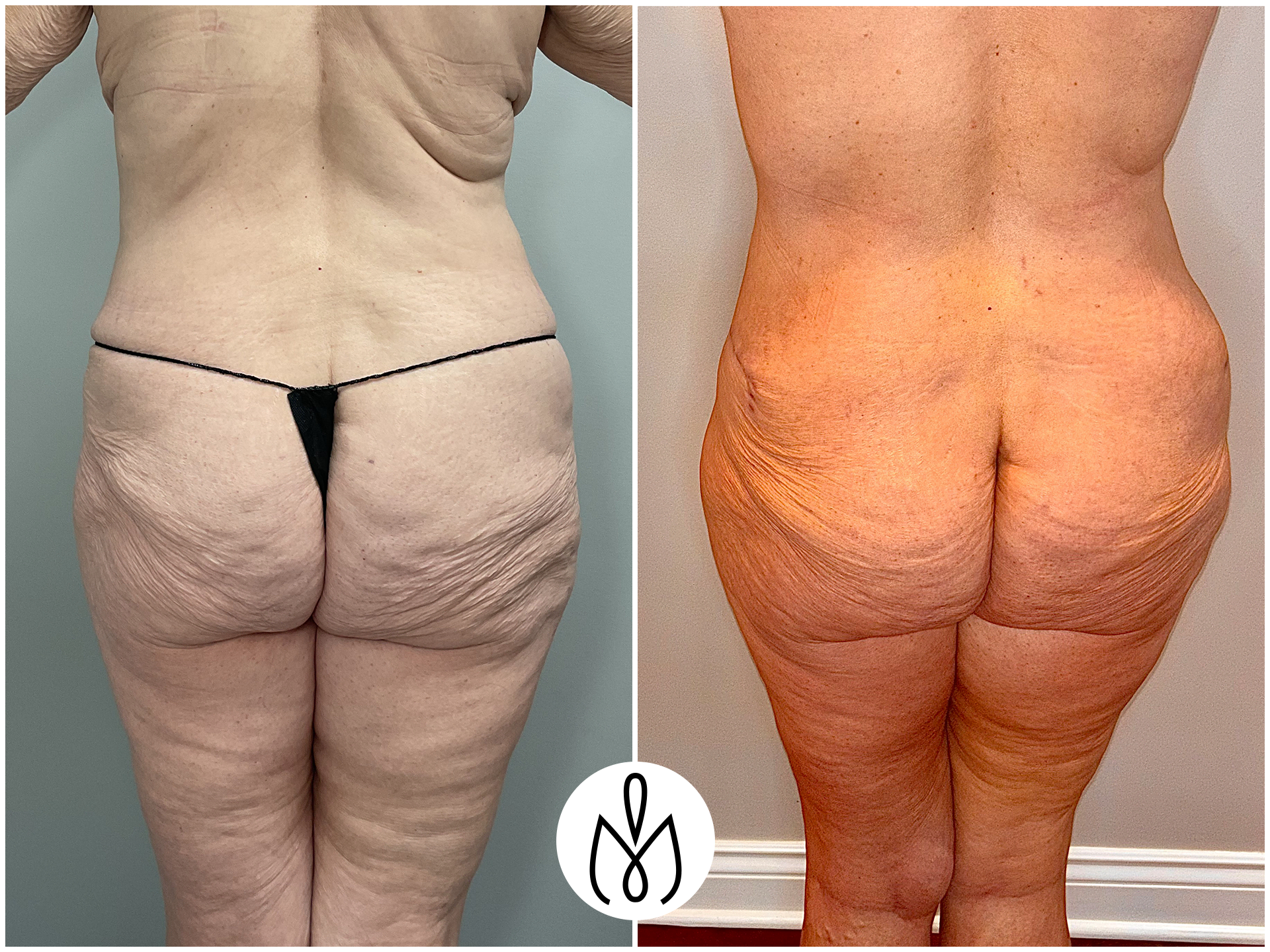 Before,After