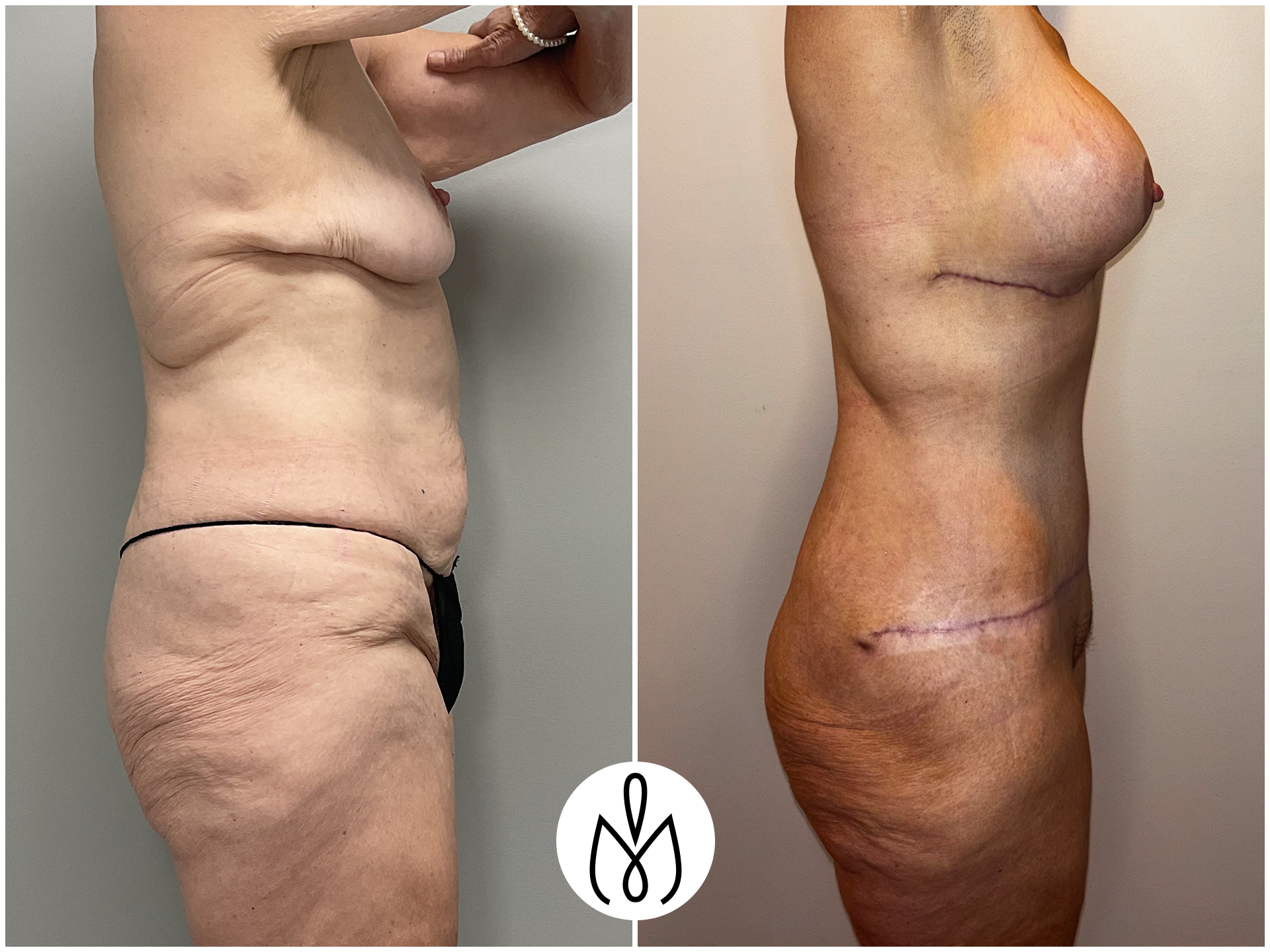 Before,After