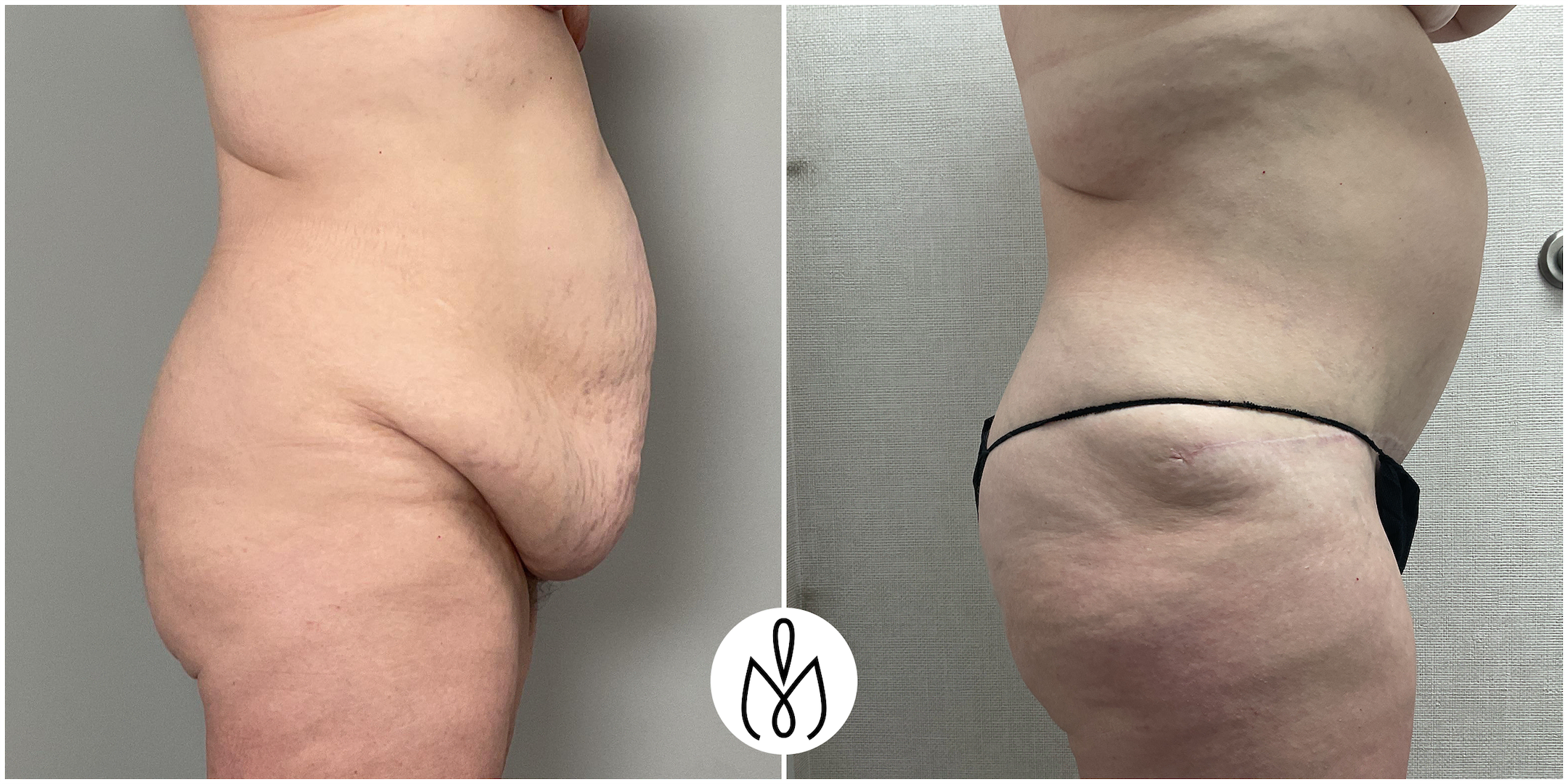 Before,After