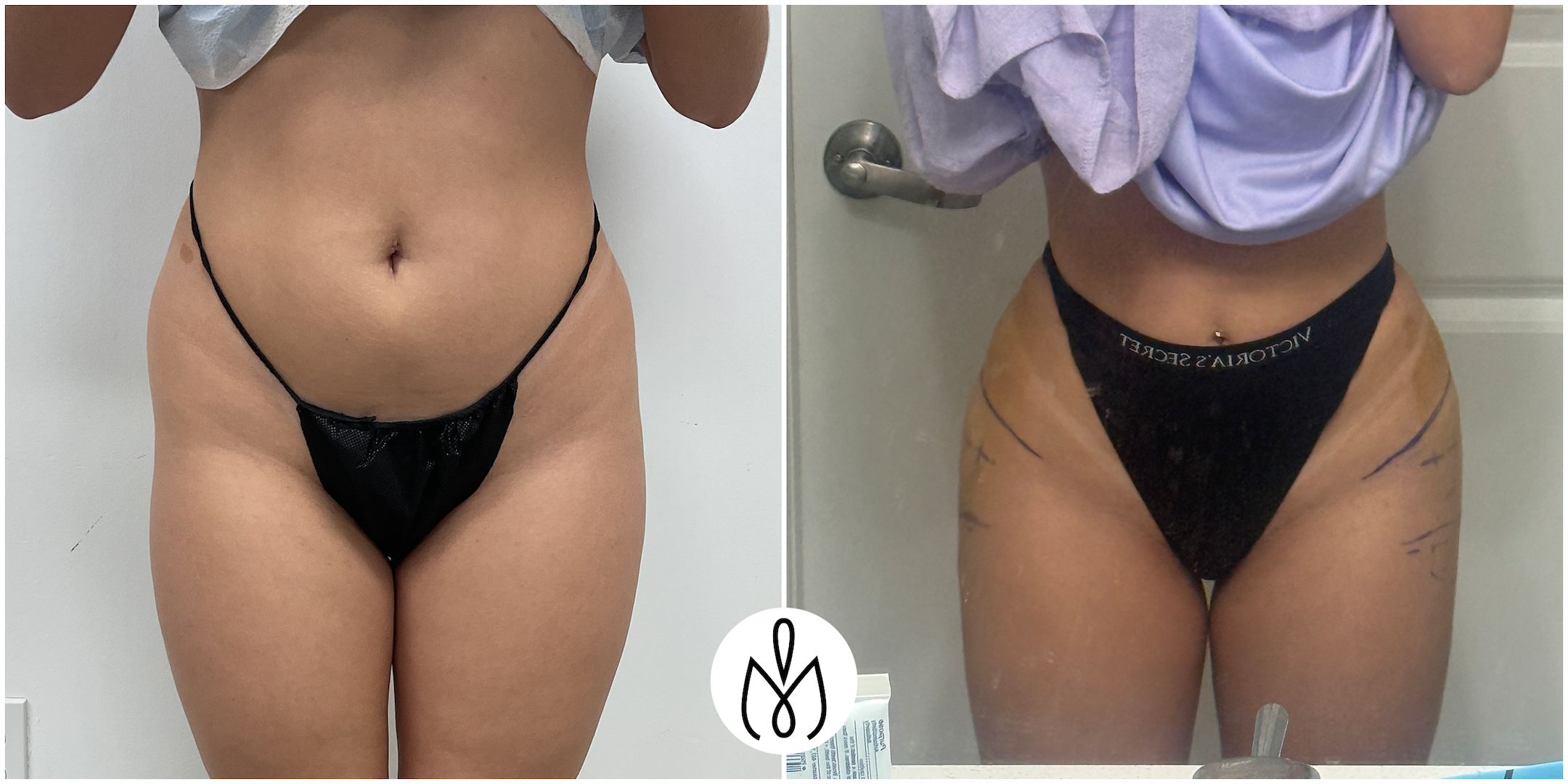Before,After