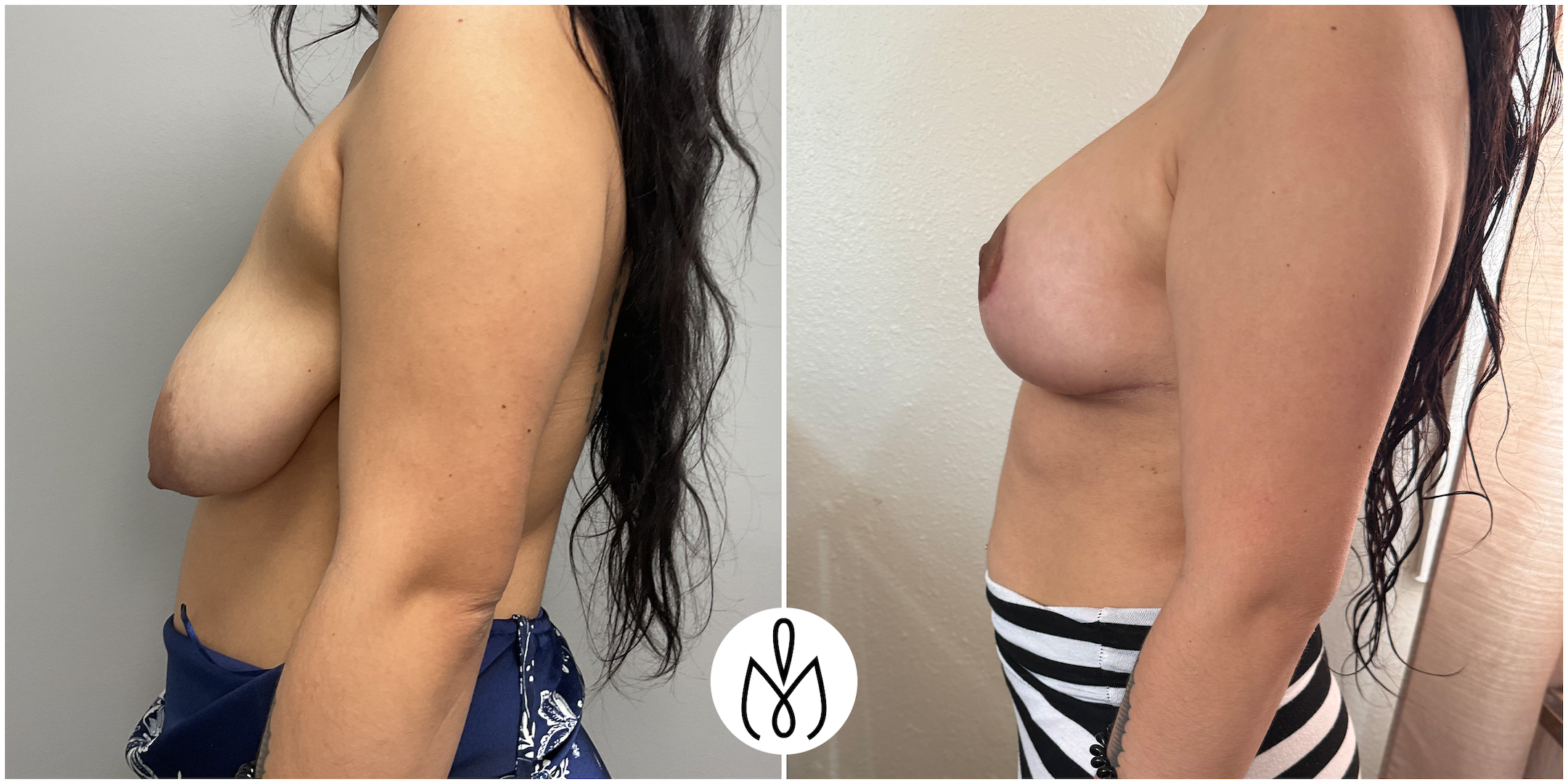 Before,After