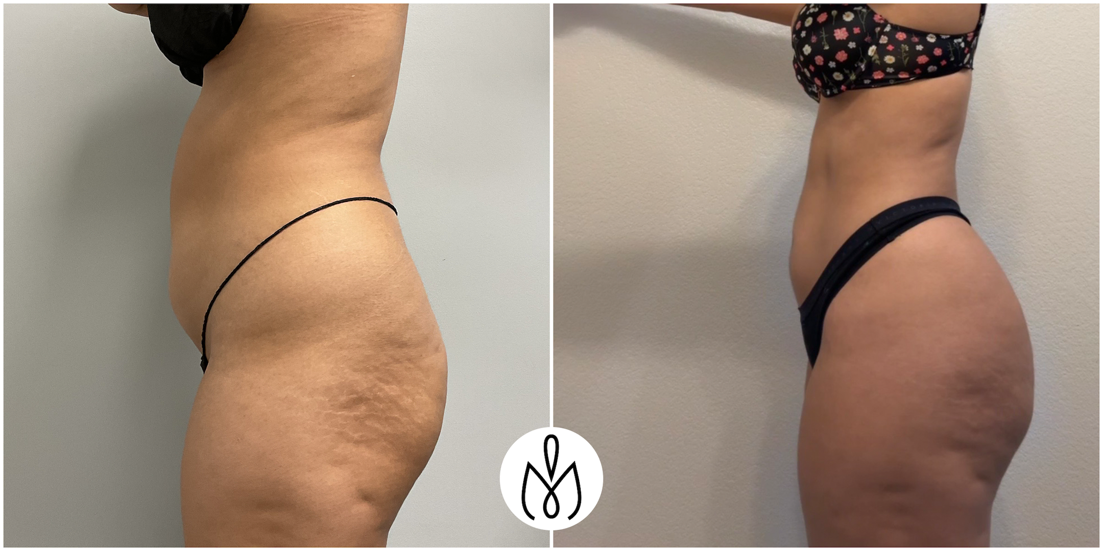 Before,After