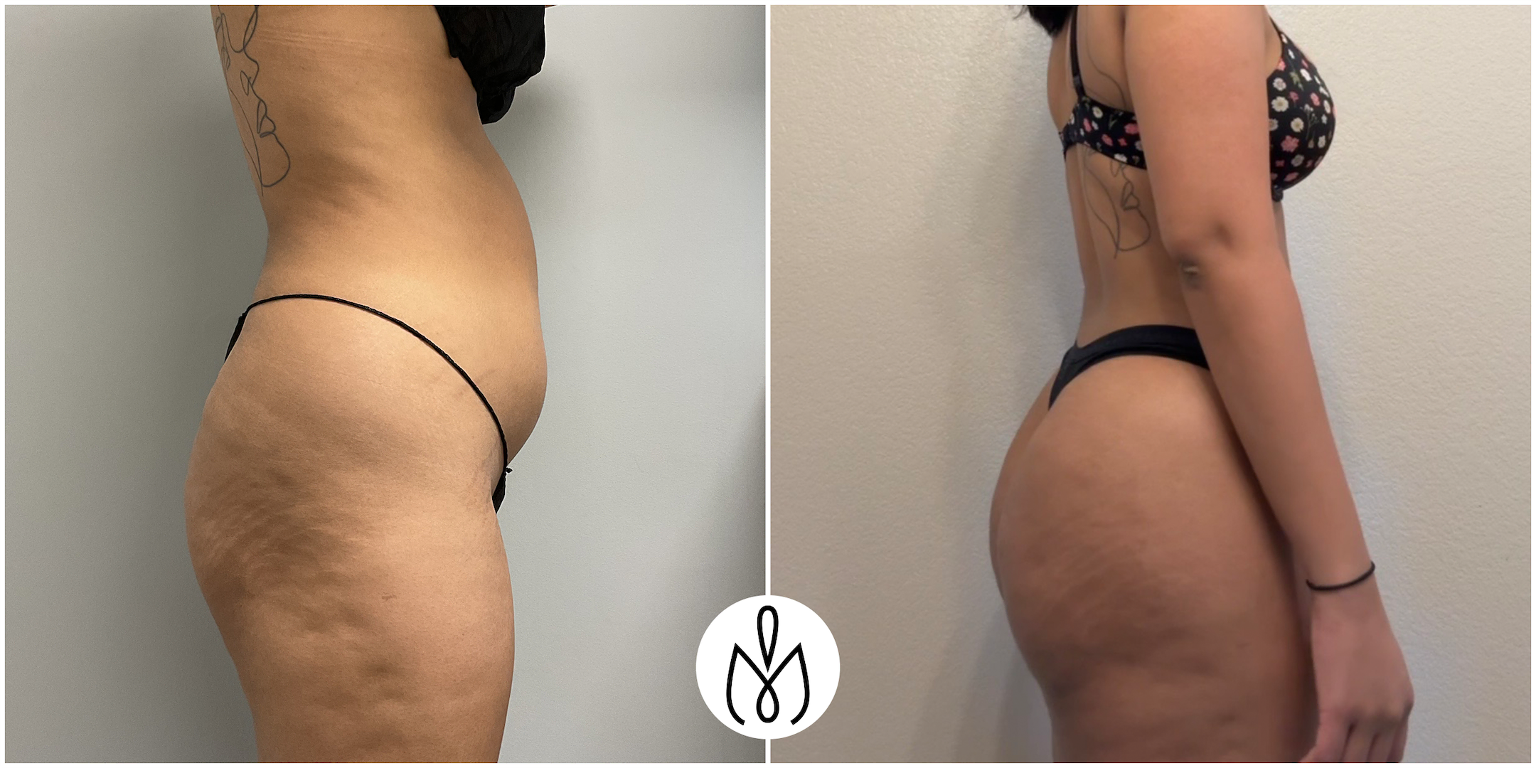 Before,After
