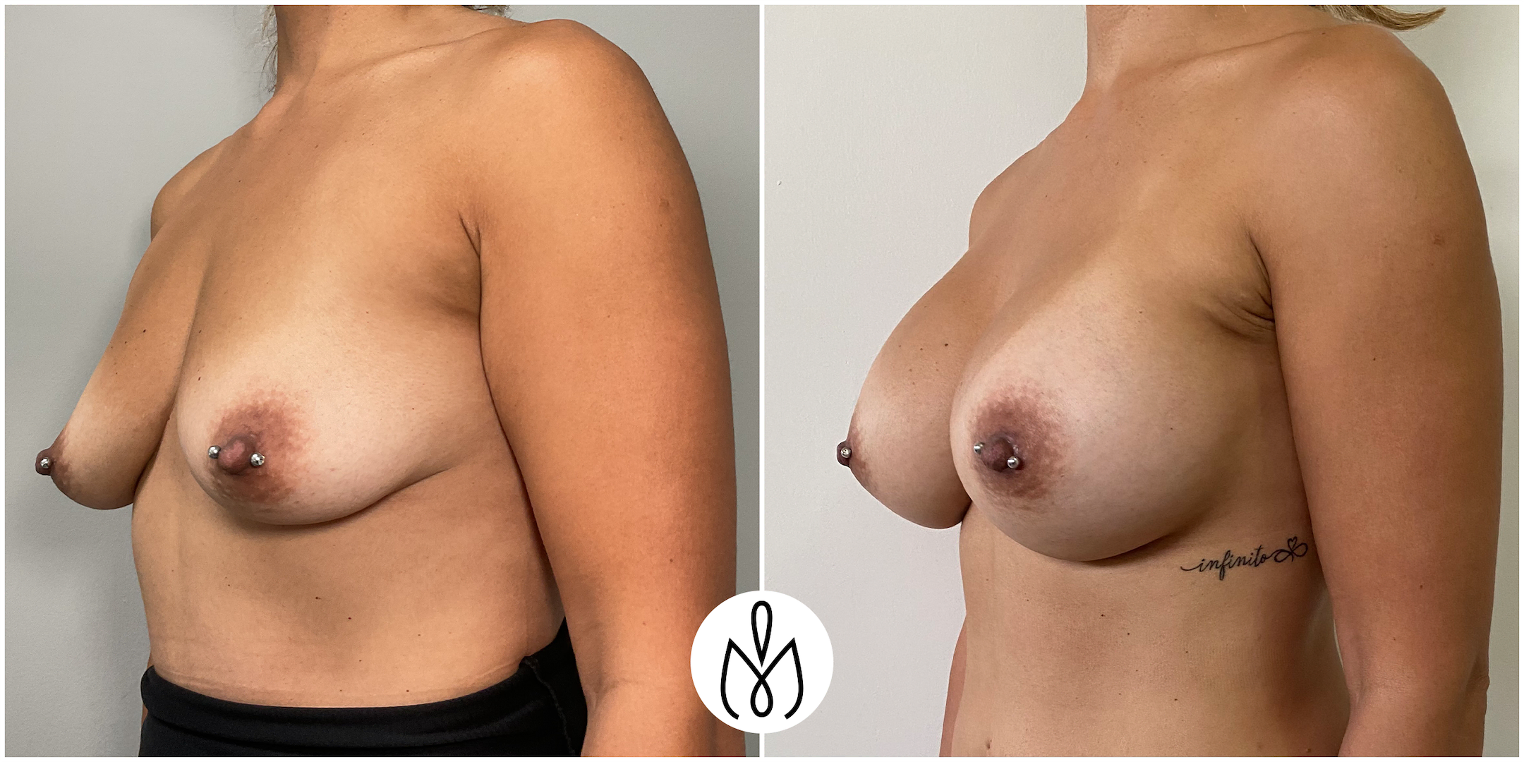 Before,After