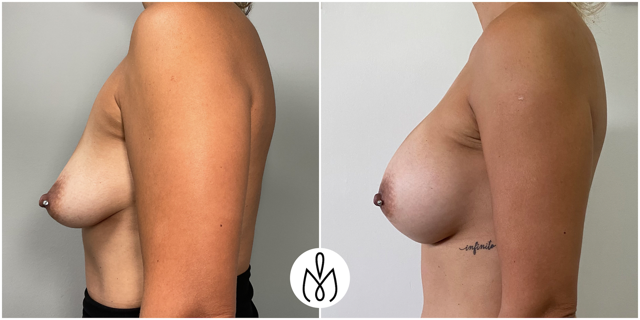Before,After
