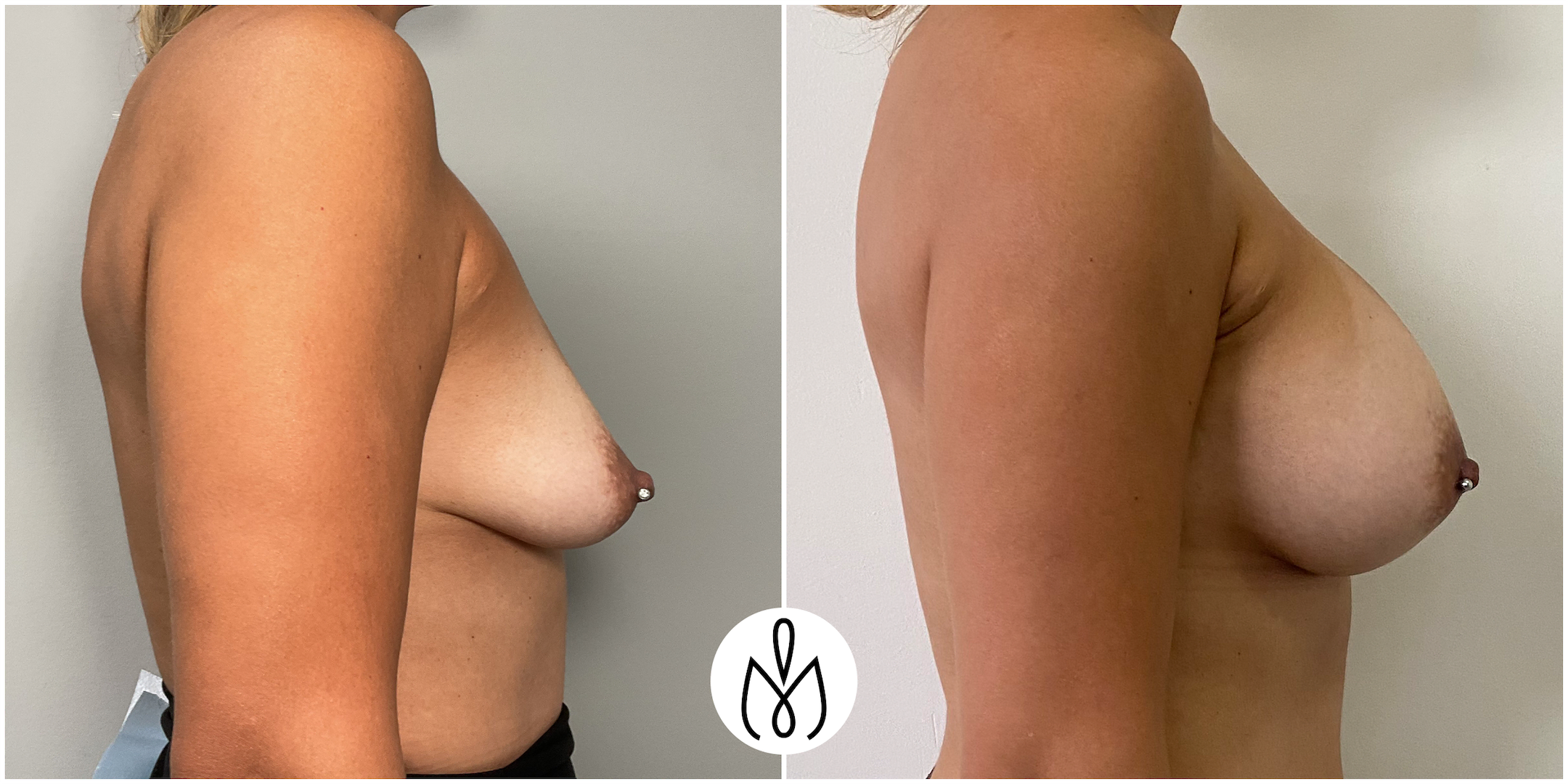 Before,After