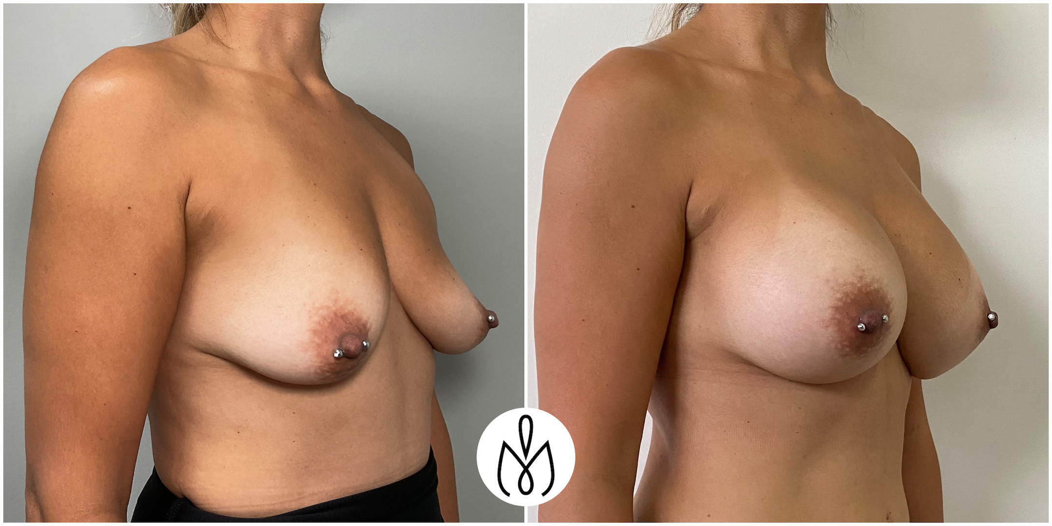 Before,After