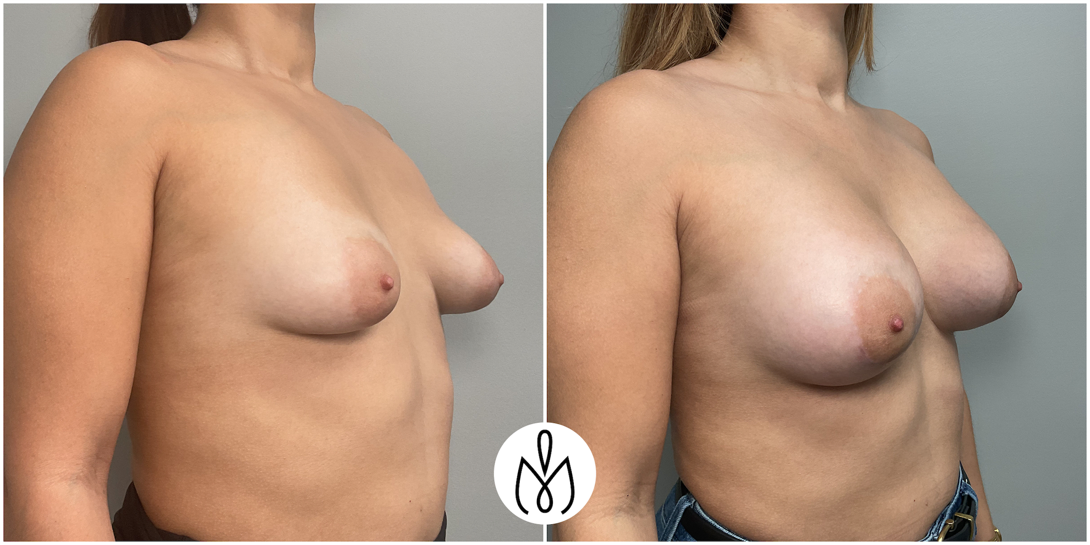 Before,After