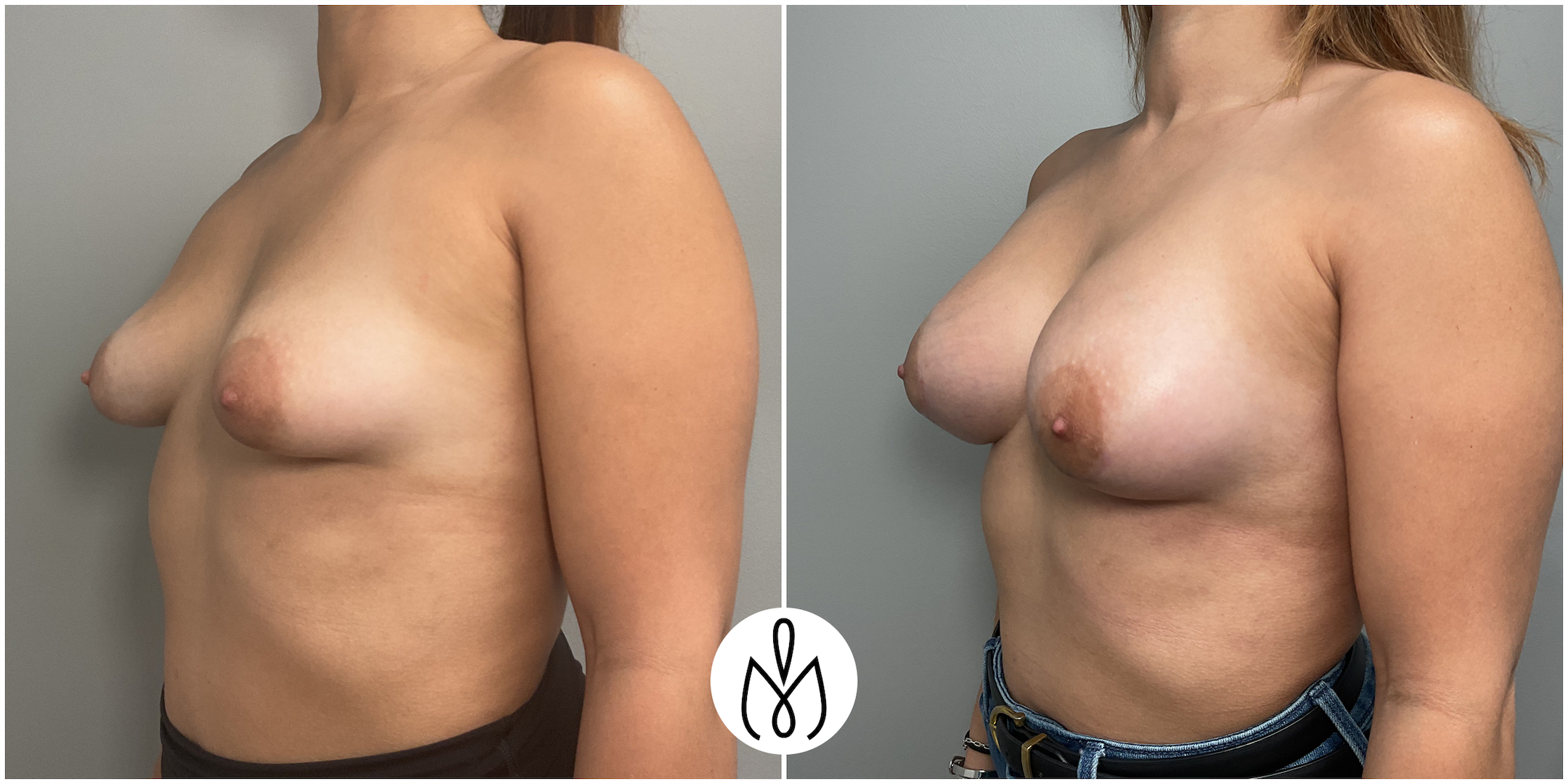 Before,After
