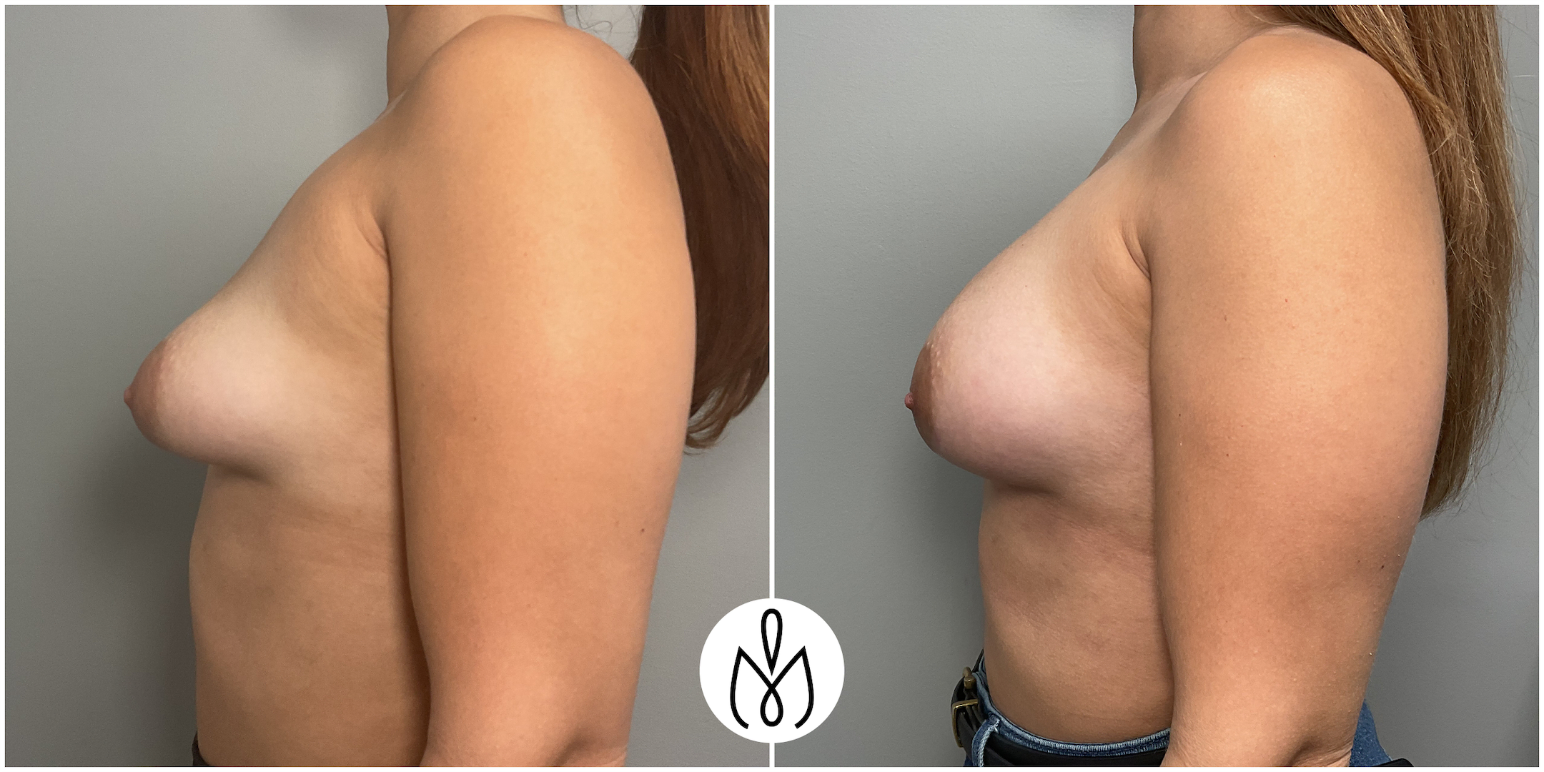 Before,After