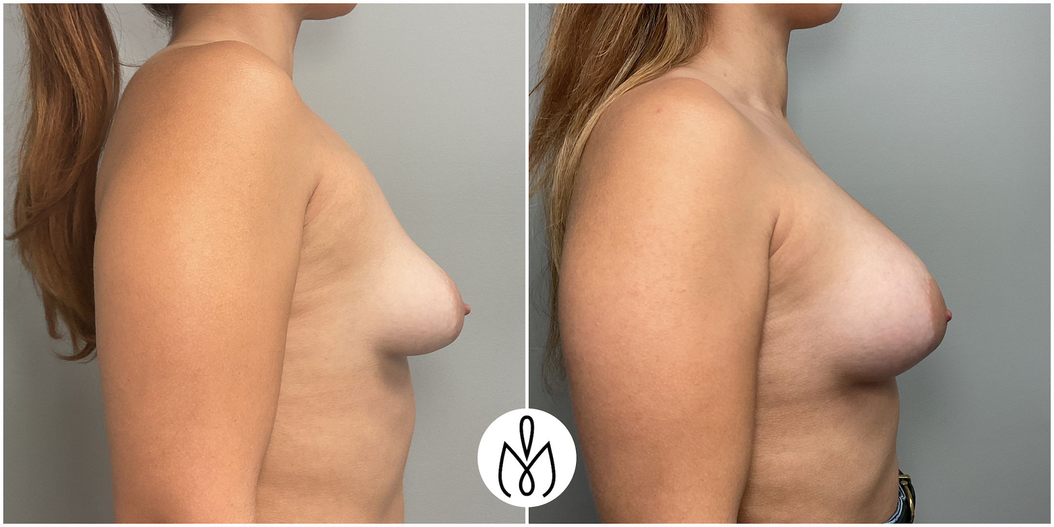 Before,After
