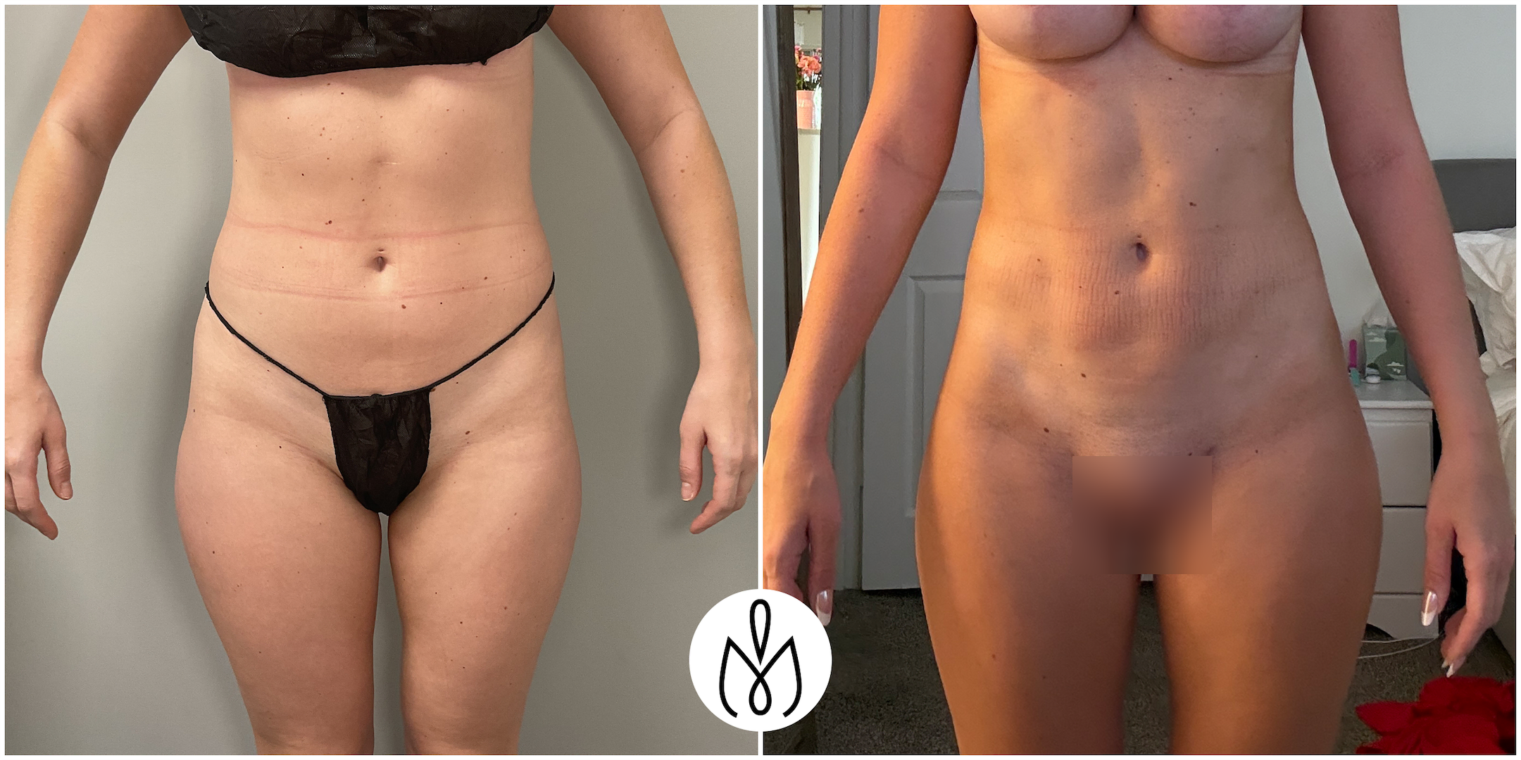 Before,After