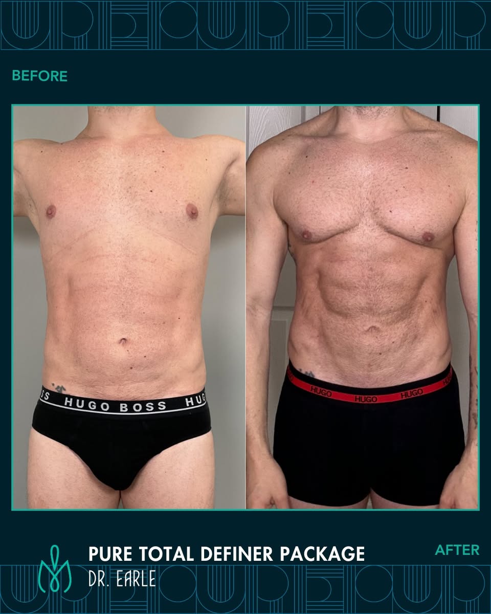Total Definer Liposculpture vs. Traditional Liposuction: Creating High-Definition Abs and Athletic Curves