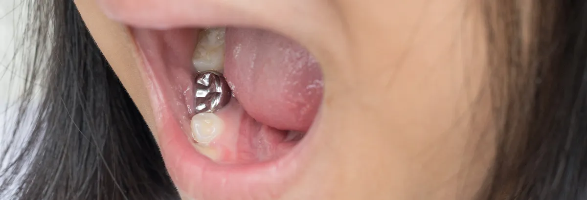 Close-up of a pediatric crown on a child’s molar in San Jose