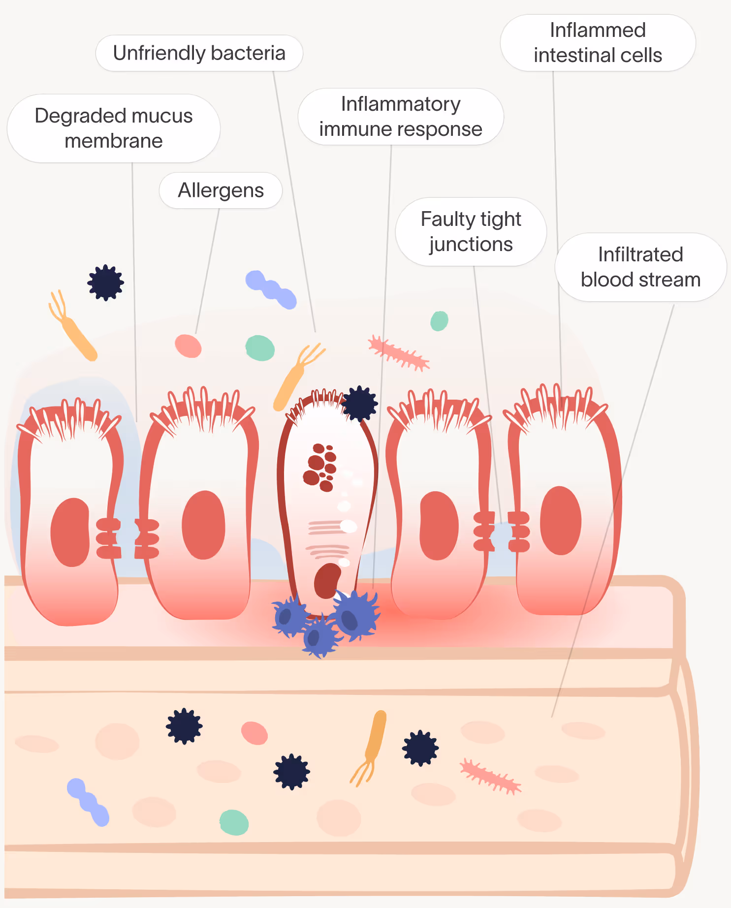 a diagram of an inflamed gut after leaky gut syndrome