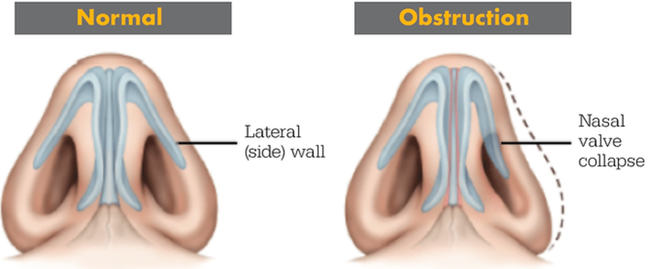 Diagram comparing normal nasal airflow with nasal valve collapse, illustrating airflow restriction and how nasal strips support the external nasal valve in athletes with structural nasal limitations.