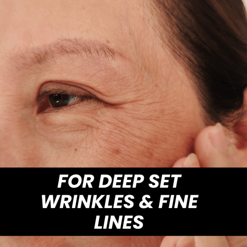 Advanced Wrinkle-Reduction — multi-visit bundle