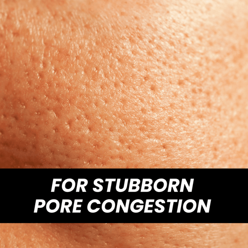 Clean, refreshed skin after decongestion package